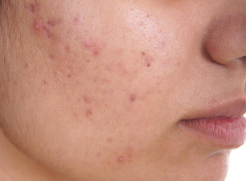Dealing with Acne Problems