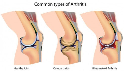 Arthritis in Athletes